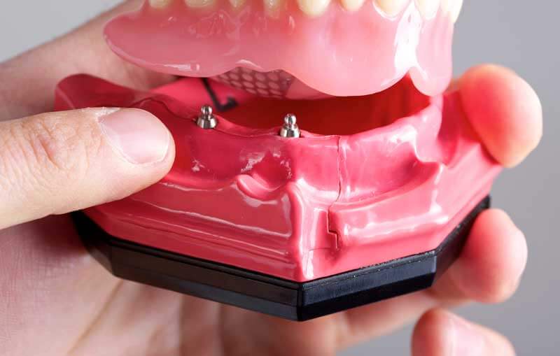 Mini Dental Implants